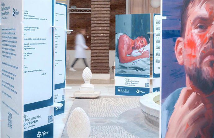 El Virgen del Rocío acoge una exposición sobre dermatitis atópica grave que afecta a 1,5 millones de adultos